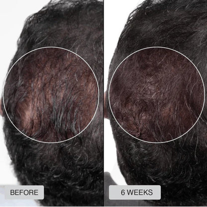 Red Light Therapy Cap for Hair Regrowth Treatments