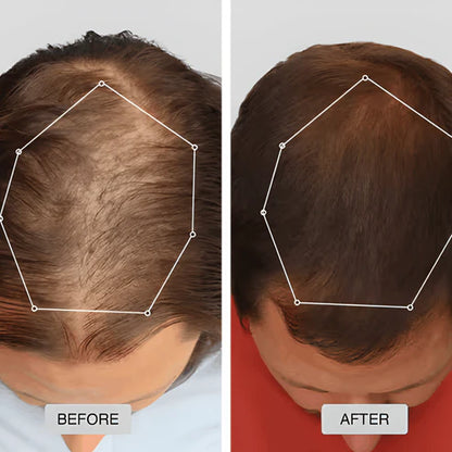 Red Light Therapy Cap for Hair Regrowth Treatments